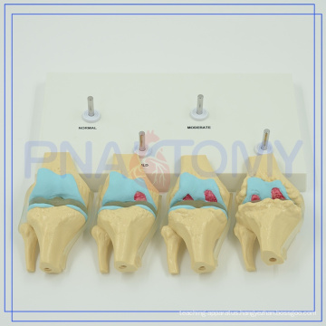 PNT-0141 Human skeleton model High quality Knee pathological model